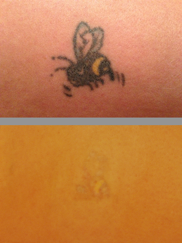 Gallery ~ Beloved Tattoo Removal