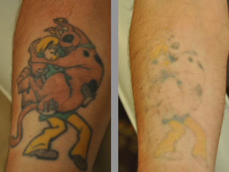 Gallery ~ Beloved Tattoo Removal